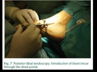 Rejul   journal club- tendoscopy