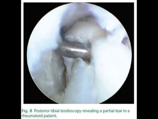 Rejul   journal club- tendoscopy