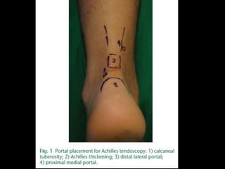 Rejul   journal club- tendoscopy