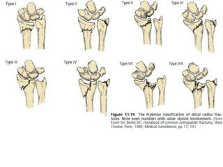 Distal Radius Fractures- Journal club | PPTX