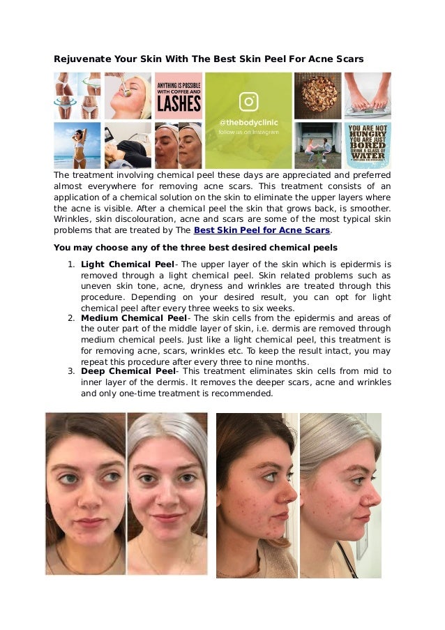 best acid peel for acne scars