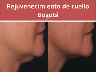 Rejuvenecimiento de cuello
         Bogotá
 