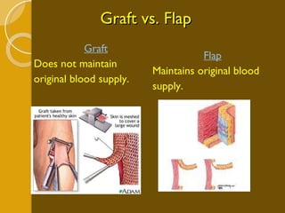 Graft vs. Flap Graft Does not maintain original blood supply. Flap Maintains original blood supply. 