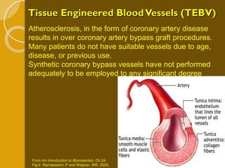 Tissue Engineered Blood Vessels (TEBV) From  An Introduction to Biomaterials.  Ch 24.  Fig.4  Ramaswami, P and Wagner, WR. 2005.  Atherosclerosis, in the form of coronary artery disease results in over coronary artery bypass graft procedures. Many patients do not have suitable vessels due to age, disease, or previous use. Synthetic coronary bypass vessels have not performed adequately to be employed to any significant degree  