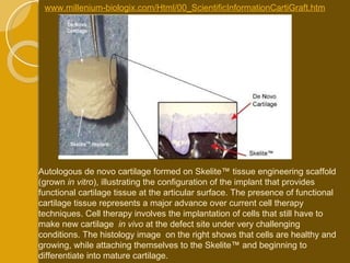www.millenium-biologix.com/Html/00_ScientificInformationCartiGraft.htm Autologous de novo cartilage formed on Skelite™ tissue engineering scaffold (grown  in vitro ), illustrating the configuration of the implant that provides functional cartilage tissue at the articular surface. The presence of functional cartilage tissue represents a major advance over current cell therapy techniques. Cell therapy involves the implantation of cells that still have to make new cartilage  in vivo  at the defect site under very challenging conditions. The histology image  on the right shows that cells are healthy and growing, while attaching themselves to the Skelite™ and beginning to differentiate into mature cartilage. 