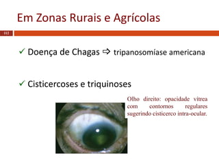 Em Zonas Rurais e Agrícolas
112
 Doença de Chagas  tripanosomíase americana
 Cisticercoses e triquinoses
Olho direito: opacidade vítrea
com contornos regulares
sugerindo cisticerco intra-ocular.
 