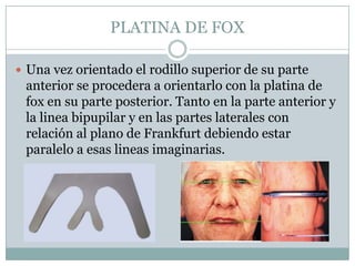 PLATINA DE FOX

 Una vez orientado el rodillo superior de su parte
 anterior se procedera a orientarlo con la platina de
 fox en su parte posterior. Tanto en la parte anterior y
 la linea bipupilar y en las partes laterales con
 relación al plano de Frankfurt debiendo estar
 paralelo a esas lineas imaginarias.
 