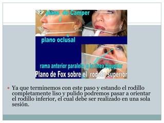  Ya que terminemos con este paso y estando el rodillo
 completamente liso y pulido podremos pasar a orientar
 el rodillo inferior, el cual debe ser realizado en una sola
 sesión.
 