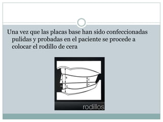 Una vez que las placas base han sido confeccionadas
 pulidas y probadas en el paciente se procede a
 colocar el rodillo de cera
 