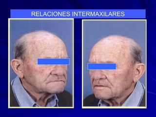 RELACION INTERMAXILAR , VERTICAL Y HORIZONTAL.ppt