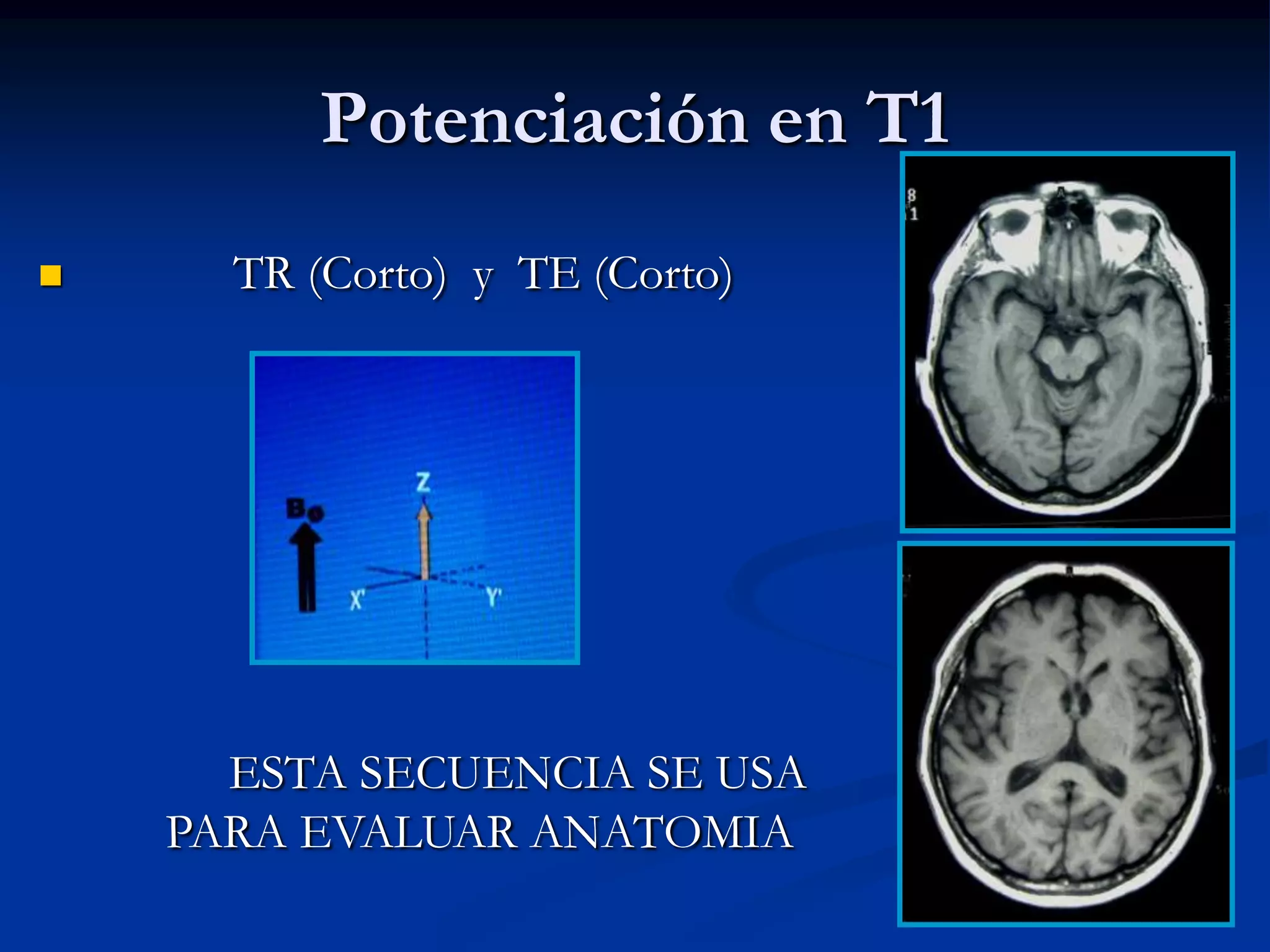 Potenciación en T1
     TR (Corto) y TE (Corto)




      ESTA SECUENCIA SE USA
    PARA EVALUAR ANATOMIA
 