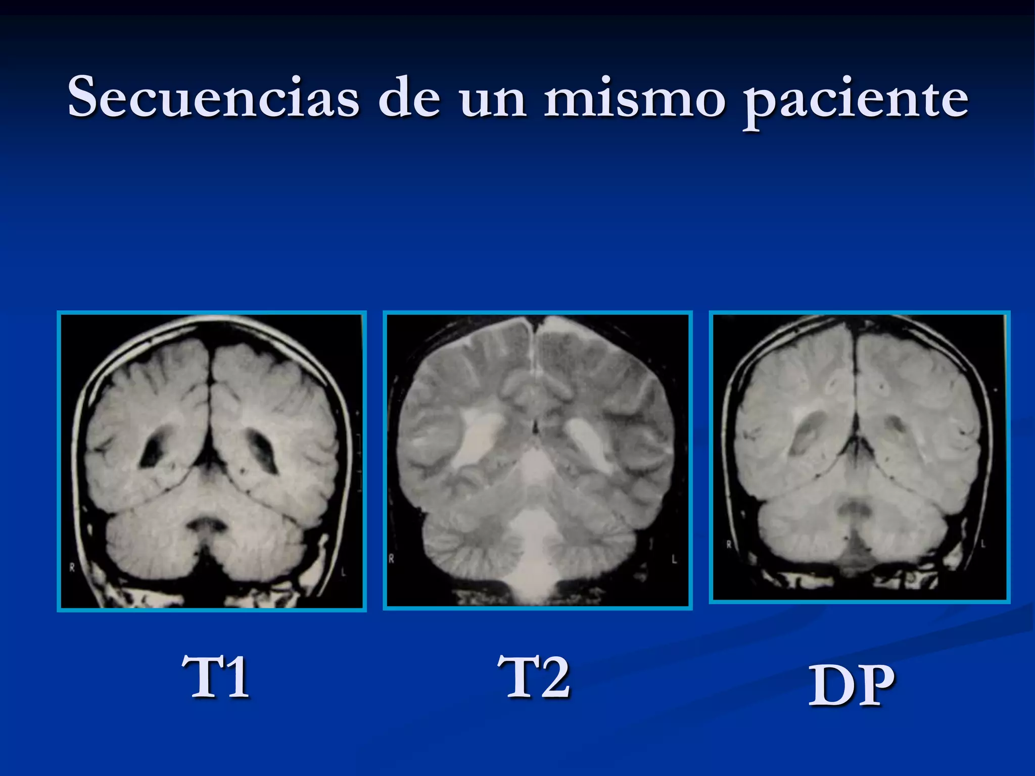Secuencias de un mismo paciente




   T1         T2         DP
 