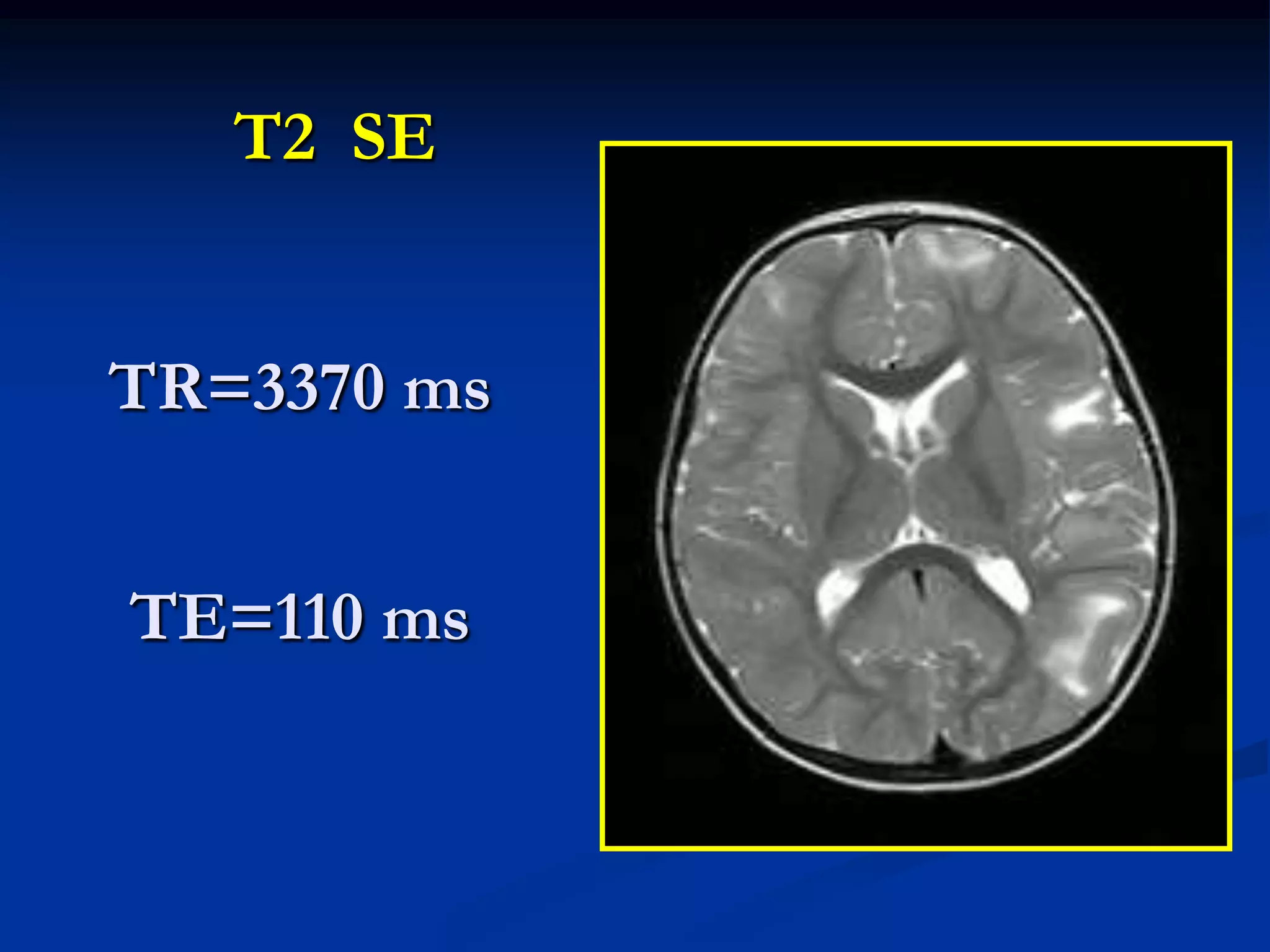 T2 SE


TR=3370 ms


TE=110 ms
 