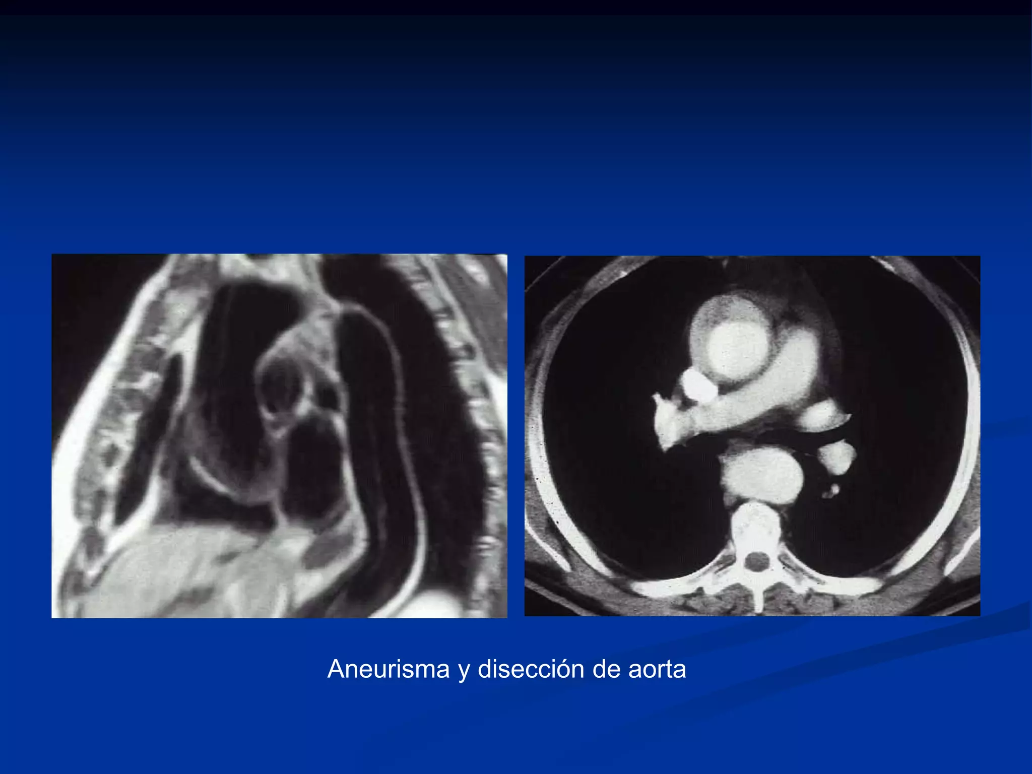 Aneurisma y disección de aorta
 