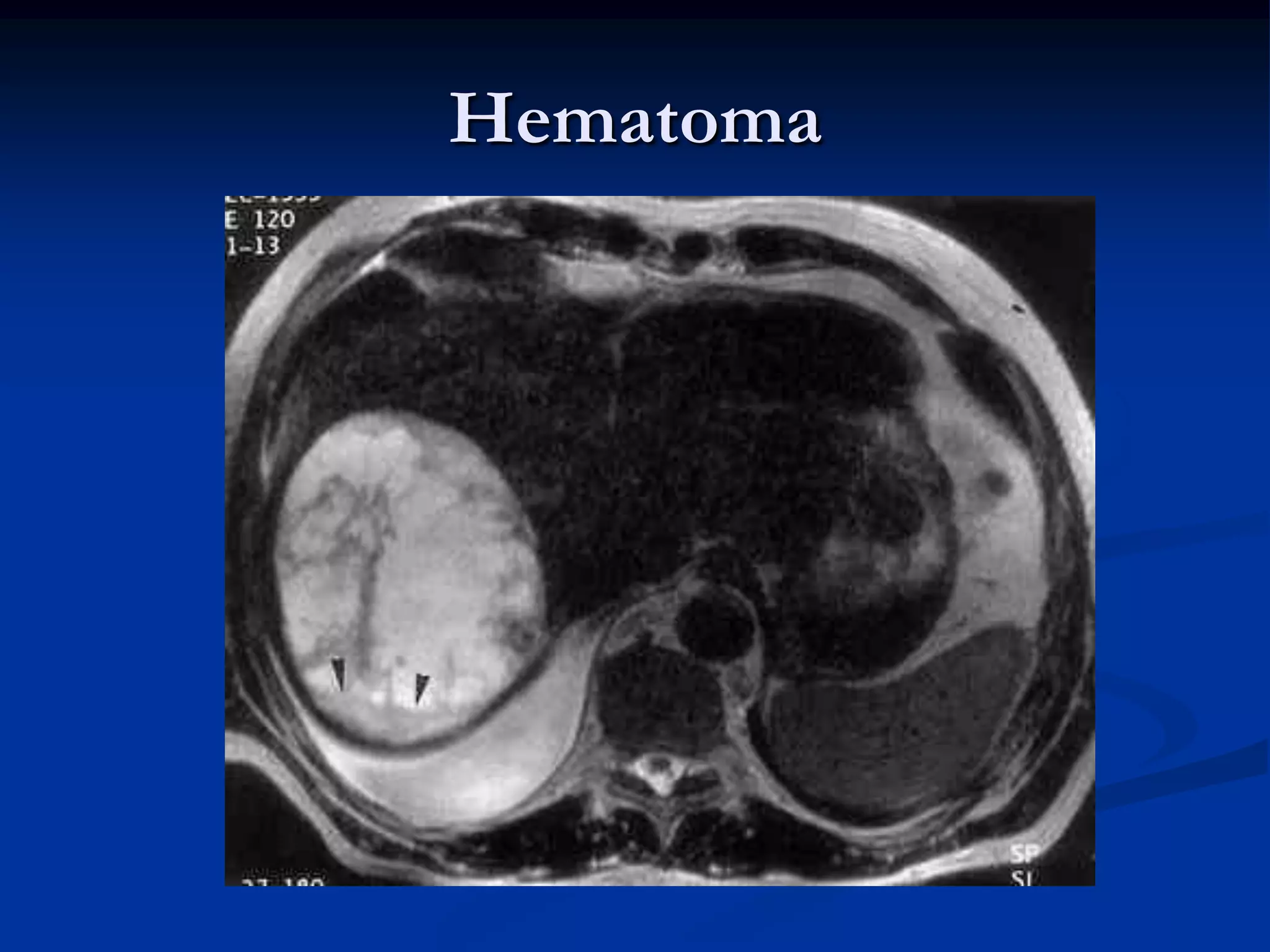 Hematoma
 