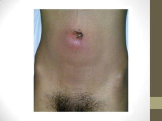 Related umbilical disorders