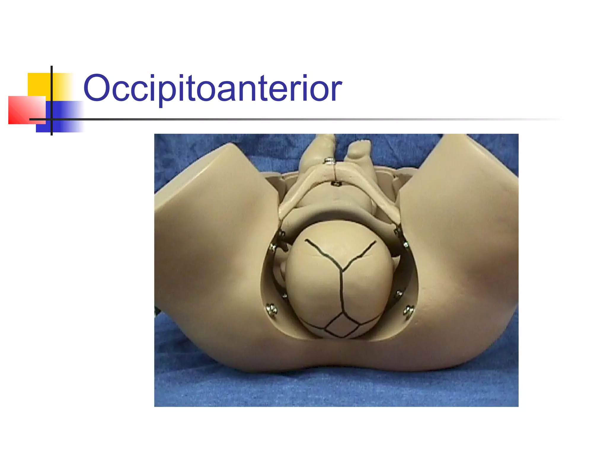 Occipitoanterior
 
