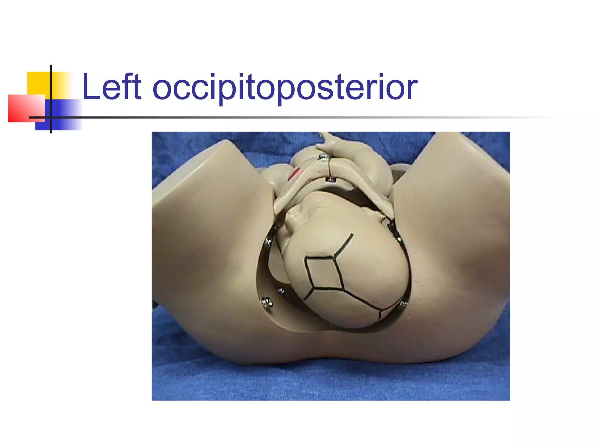 Left occipitoposterior
 