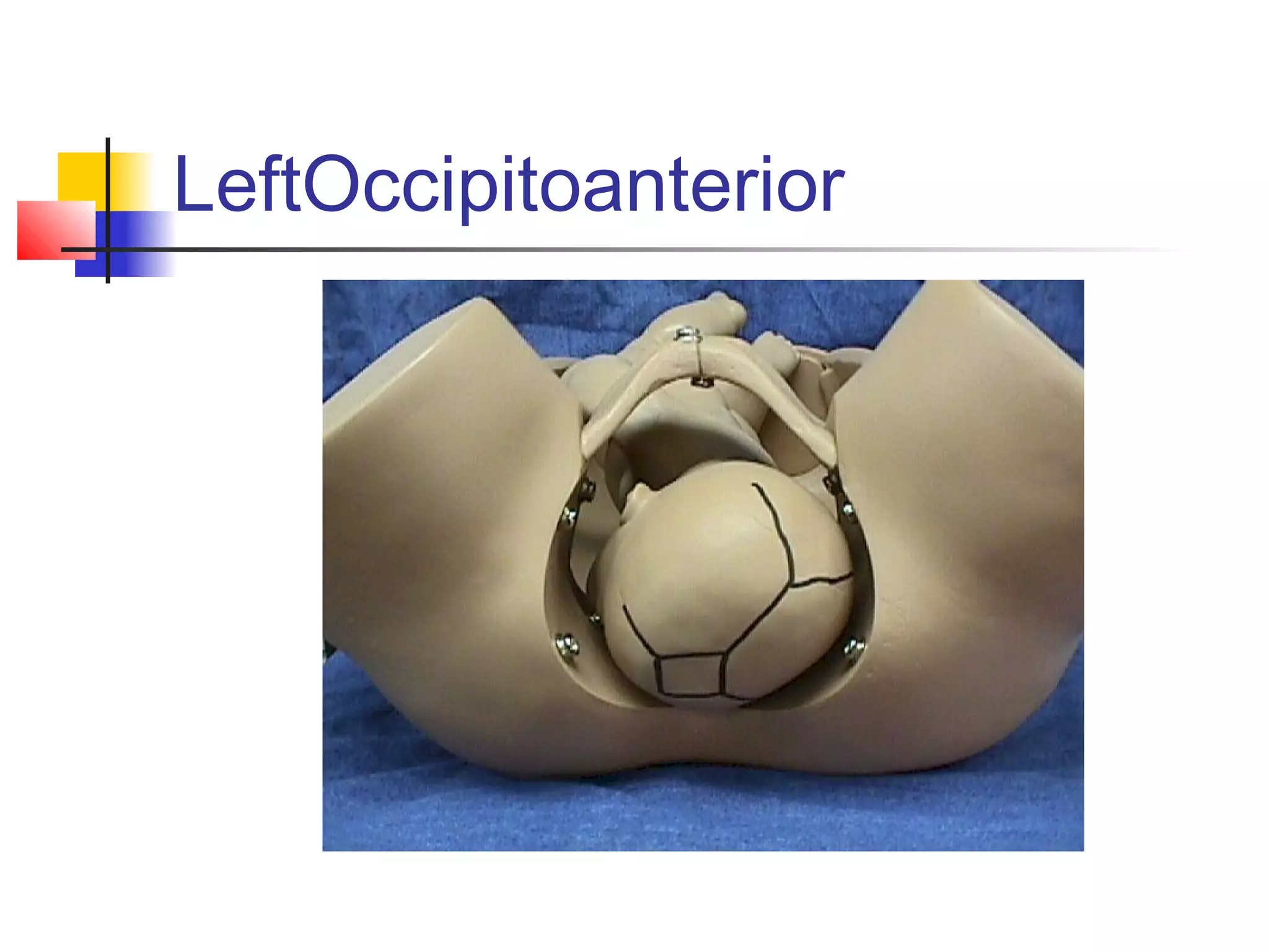 LeftOccipitoanterior
 