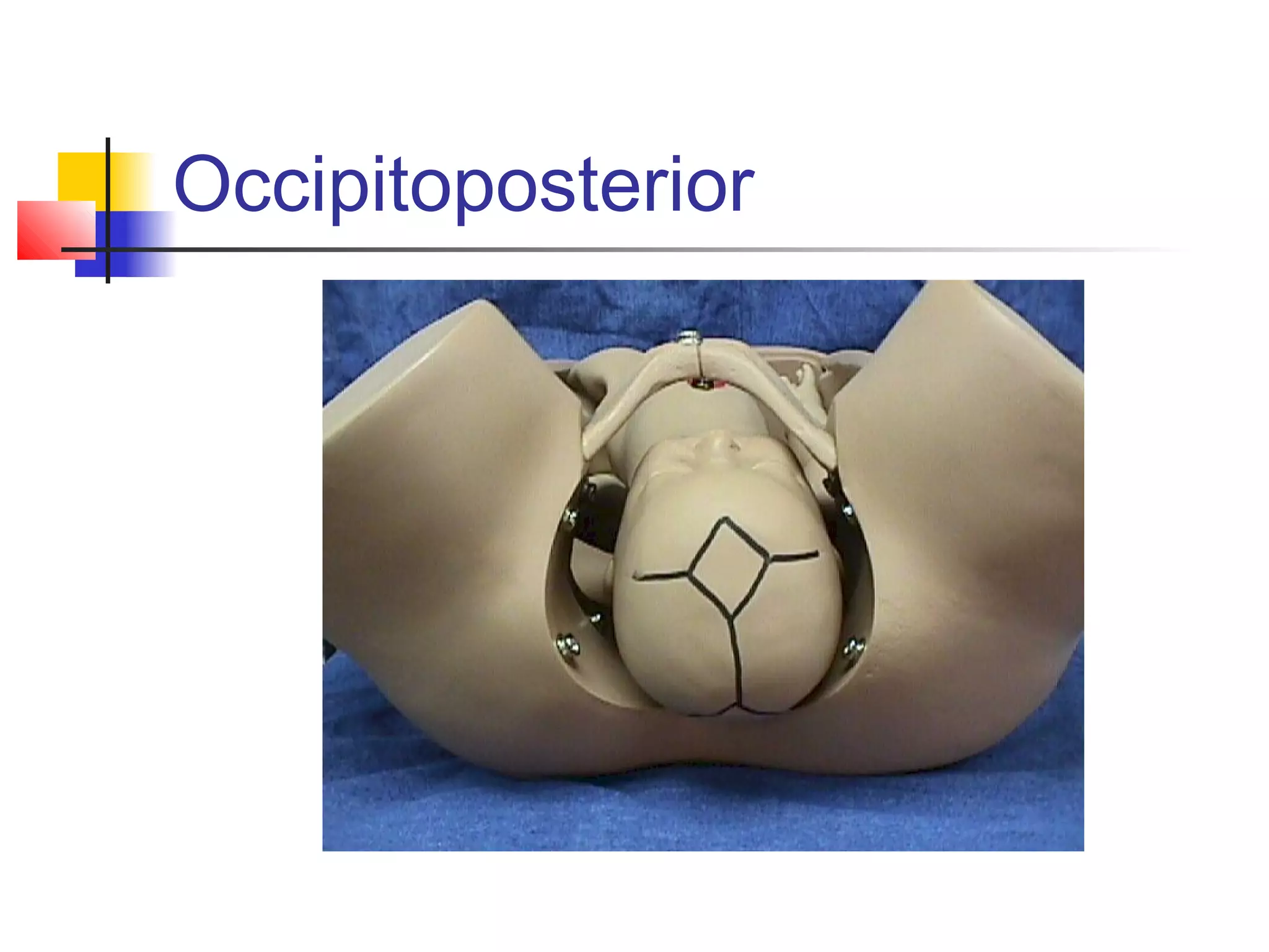 Occipitoposterior
 