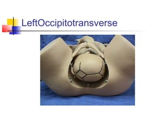 LeftOccipitotransverse
 