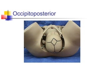 Occipitoposterior
 