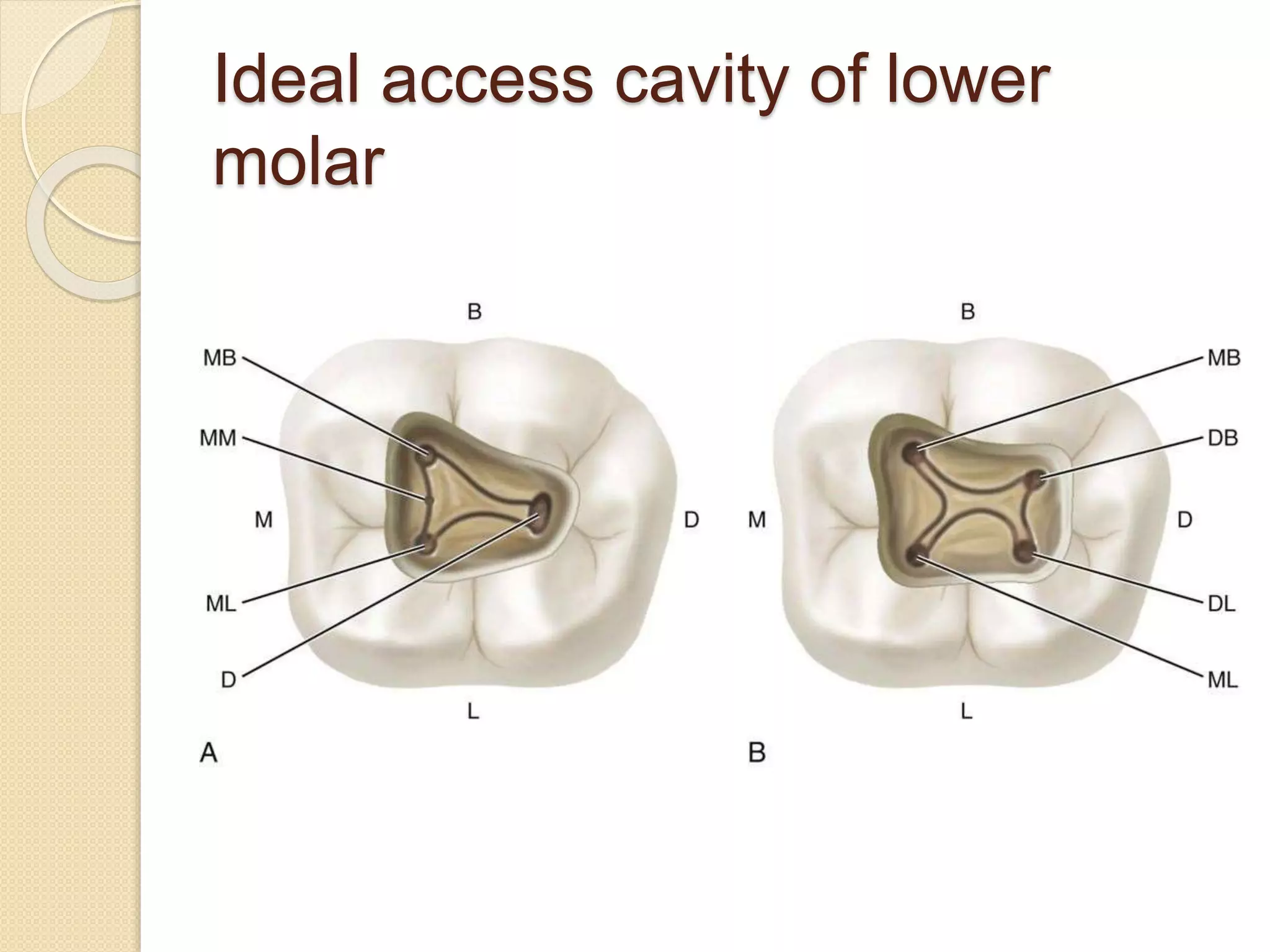 Ideal access cavity of lower
molar
 
