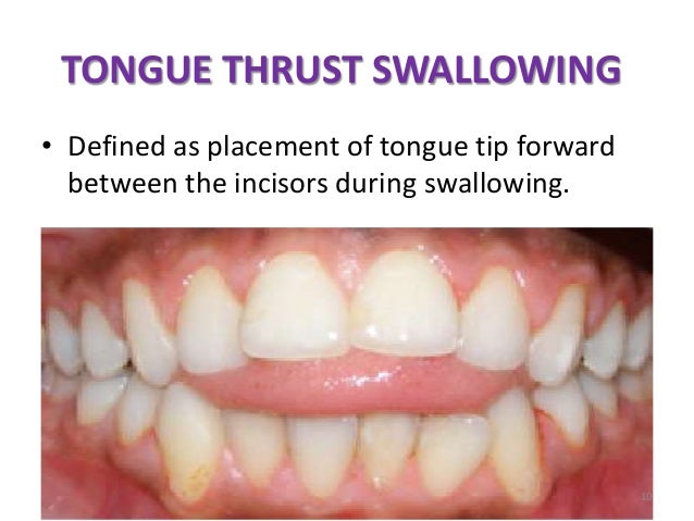 malocclusion
