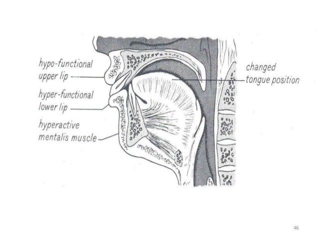 relationship between orofacial muscles function and malocclusion