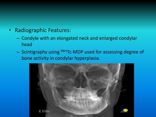 Relationship of tmj anatomy and pathology and related | PPTX