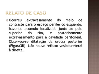  Ocorreu   extravasamento do meio de
 contraste para o espaço periférico esquerdo,
 havendo acúmulo localizado junto ao polo
 superior    do   rim,   e    posteriormente
 extravasamento para a cavidade peritoneal.
 Observou-se dilatação da uretra posterior
 (Figura3B). Não houve refluxo vesicoureteral
 à direita.
 