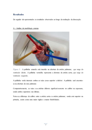 7
Resultados
De seguida são apresentados os resultados observados ao longo da realização da dissecação.
A – Análise da morfologia externa
Figura 3 – A palhinha amarela está inserida na abertura da artéria pulmonar, que surge do
ventrículo direito. A palhinha vermelha representa a abertura da artéria aorta, que surge do
ventrículo esquerdo.
A palhinha verde interseta ambas as veias cavas superior e inferior. A palhinha azul encontra-
se na abertura da veia pulmonar.
Comparativamente, as veias e as artérias diferem significativamente no calibre na espessura,
sendo ambos superiores nas últimas.
Nota-se a diferença de calibre entre a artéria aorta e a artéria pulmonar, sendo este superior na
primeira, assim como uma maior rigidez e menor flexibilidade.
 