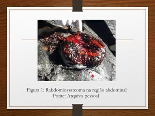 Figura 1: Rabdomiossarcoma na região abdominal
Fonte: Arquivo pessoal
 