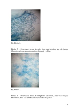 5
Fig. Lâmina 2.
Lâmina 3 – Observou-se escama de pele, viu-se macroconídios, que são fungos
filamentos na forma de conídios maiores. Contendo 6 células.
Fig. Lâmina 3.
Lâmina 4 – Observou-se lâmina de histoplama capsulatum, onde viu-se fungos
filamentosos, hifas não-septadas com microconídios nas pontas.
 