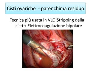 Tecnica più usata in VLO:Stripping della
cisti + Elettrocoagulazione bipolare
Cisti ovariche - parenchima residuo
 