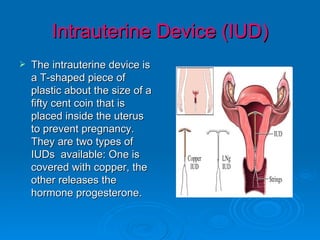 Intrauterine Device (IUD)
   The intrauterine device is
    a T-shaped piece of
    plastic about the size of a
    fifty cent coin that is
    placed inside the uterus
    to prevent pregnancy.
    They are two types of
    IUDs available: One is
    covered with copper, the
    other releases the
    hormone progesterone.
 