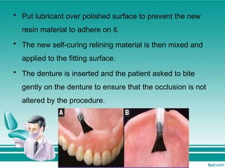 • Put lubricant over polished surface to prevent the new
resin material to adhere on it.
• The new self-curing relining material is then mixed and
applied to the fitting surface.
• The denture is inserted and the patient asked to bite
gently on the denture to ensure that the occlusion is not
altered by the procedure.
 