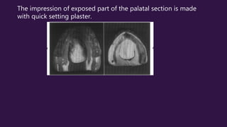 The impression of exposed part of the palatal section is made
with quick setting plaster.
 