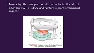 • Now adapt the base plate wax between the teeth and cast.
• after this wax up is done and denture is processed in usual
manner
 