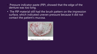 • Pressure indicator paste (PIP) ,showed that the edge of the
denture was too long.
• The PIP material still had the brush pattern on the impression
surface, which indicated uneven pressure because it did not
contact the patient’s mucosa.
 