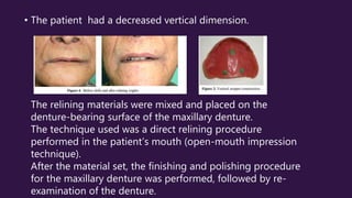 • The patient had a decreased vertical dimension.
The relining materials were mixed and placed on the
denture-bearing surface of the maxillary denture.
The technique used was a direct relining procedure
performed in the patient’s mouth (open-mouth impression
technique).
After the material set, the finishing and polishing procedure
for the maxillary denture was performed, followed by re-
examination of the denture.
 