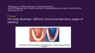 Rebasing as a Problem-Solving in Complete Dentures
Jemli S. Rebasing as a Problem-Solving in Complete Dentures. Saudi J Oral Dent Res.
2021;6(6):227-33
• Purpose
The study illustrates different clinical and laboratory stages of
rebasing.
 