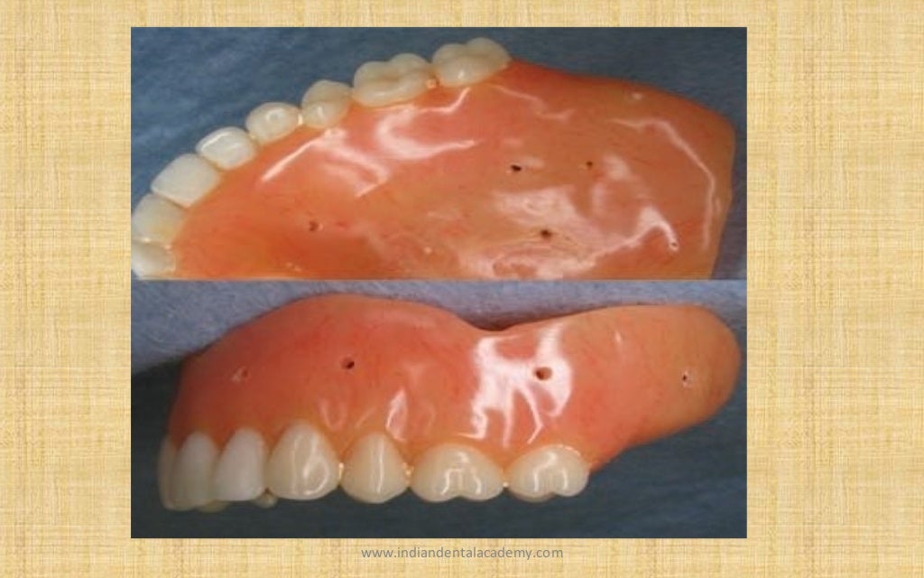 Relining and rebasing in complete dentures / Labial orthodontics cour…