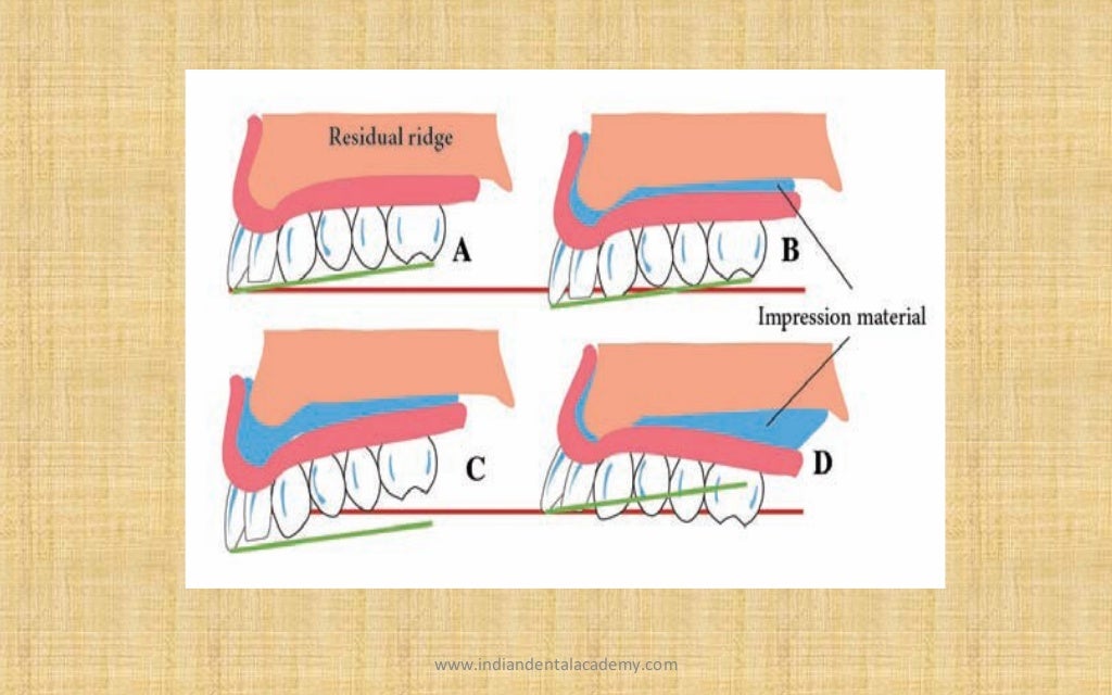 Relining and rebasing in complete dentures / Labial orthodontics cour…