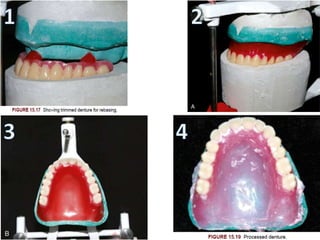 Relining and rebasing in complete dentures