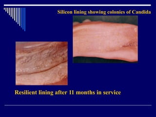 Relining In Rpd RELINING AND REPAIR OF RPD.pptxbhjyuijknbhgyuj | PPTX