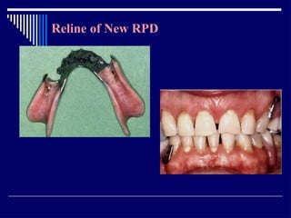 Relining In Rpd RELINING AND REPAIR OF RPD.pptxbhjyuijknbhgyuj | PPTX