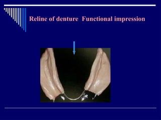 Relining In Rpd RELINING AND REPAIR OF RPD.pptxbhjyuijknbhgyuj | PPTX