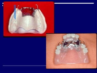 Relining In Rpd RELINING AND REPAIR OF RPD.pptxbhjyuijknbhgyuj | PPTX