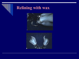 Relining In Rpd RELINING AND REPAIR OF RPD.pptxbhjyuijknbhgyuj | PPTX